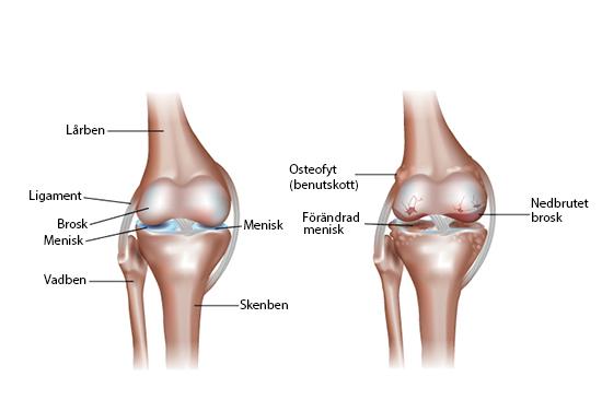 illustration av frisk och sjuk knäled med texter som pekar ut alla delar av leden: menisk, ledbrosk, ligament