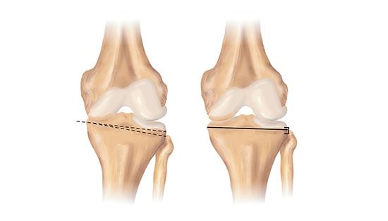 illustration av en knäled före och efter en osteotomi