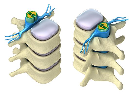 illustration av ryggens anatomi som visar ryggradens kotor, diskar och ryggmärgen