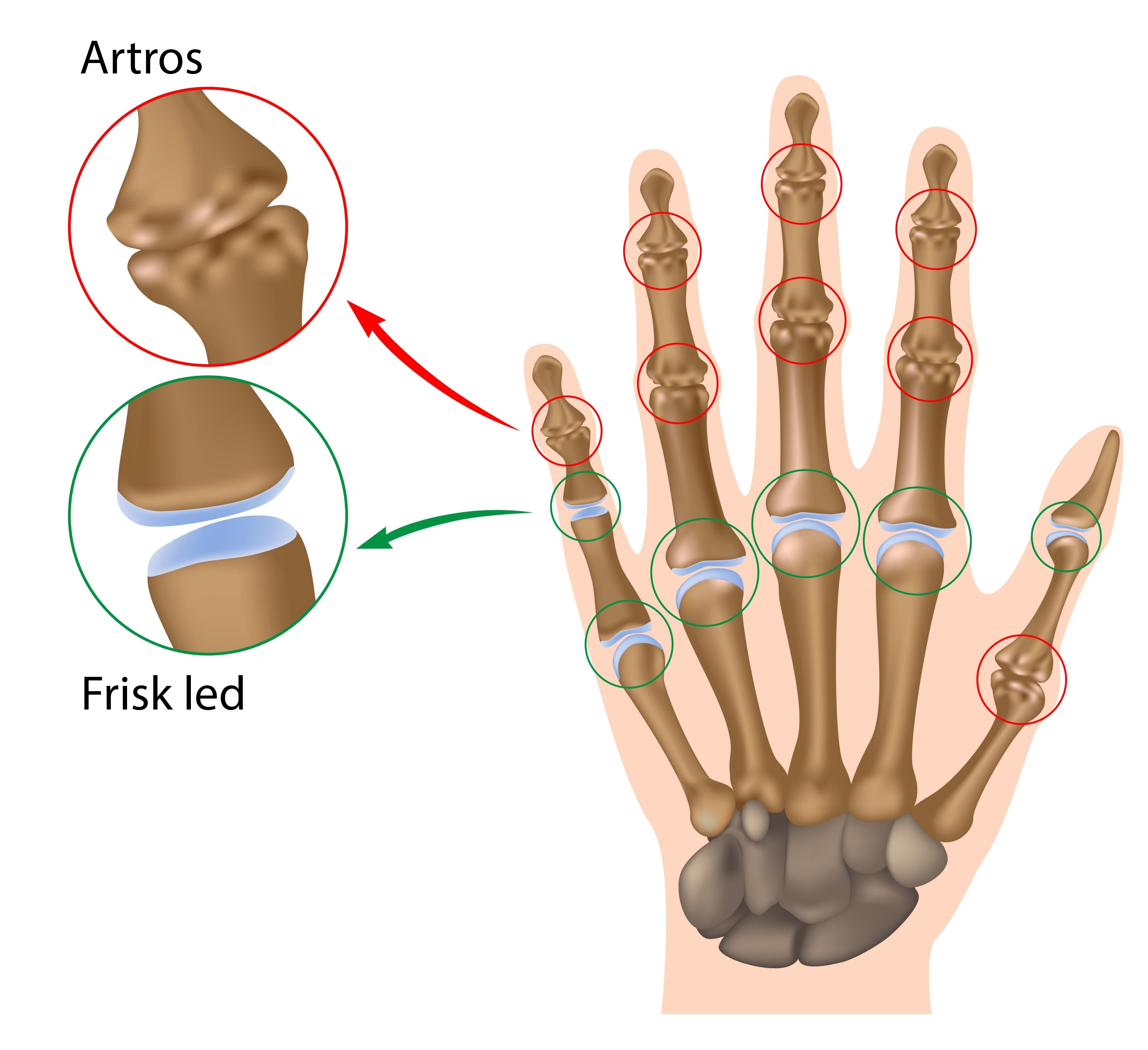 illustration av frisk han respektive hand med artros i fingerlederna