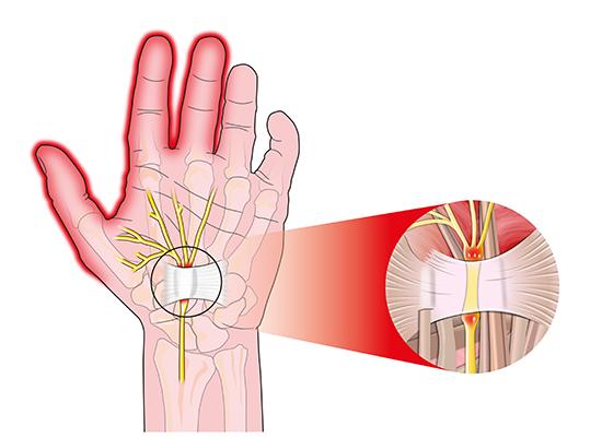 illustration av hand med karpaltunnelsyndrom som visar den nerv som ligger i kläm
