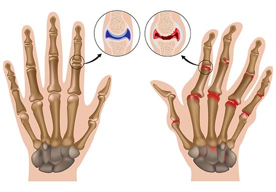 illustration av frisk hand och hand med reumatoid artrit, ett tillstånd som kan ge ont i händerna